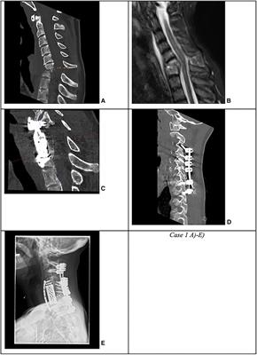 Clinical and surgical outcome in patients with cervical spondylodiscitis—a single-center retrospective case series of 24 patients